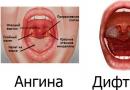 Когда болит горло, чем полоскать в домашних условиях?